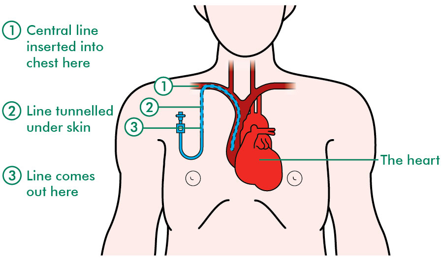 Central-line-labelled_tcm9-45587